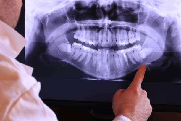Best Emergency Tooth Extraction in Crugers, NY